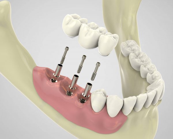 Prothese-sur-implants